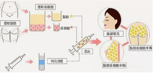 厦门薇格自体脂肪隆胸效果如何？结合日记价格分析值不值