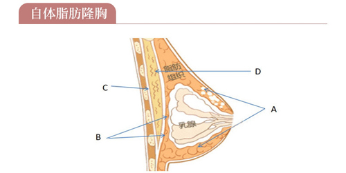 厦门薇格自体脂肪隆胸效果如何？结合日记价格分析值不值