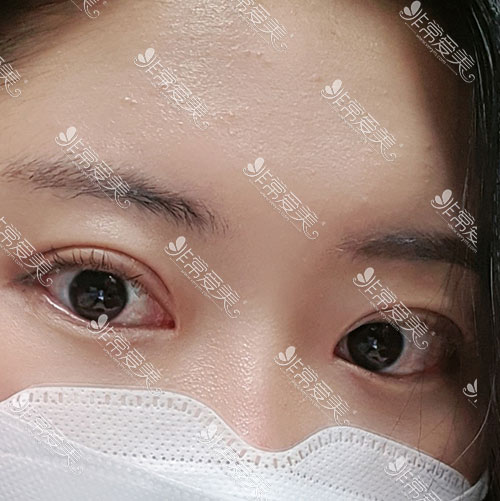 韩国yellow整形外科双眼皮手术案例