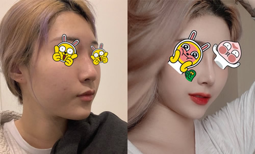 韩国Ucanb整形外科驼峰鼻矫正真人案例