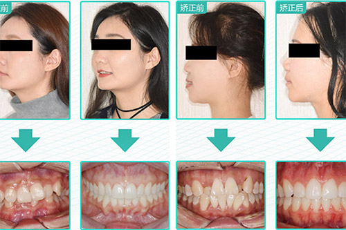 牙齿矫正反馈图