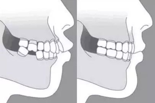龅牙矫正示意图