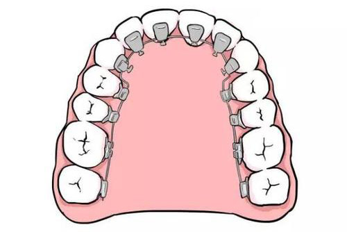 舌侧矫正示意图