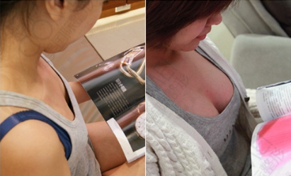 南京康美自体脂肪隆胸前后对比