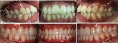 北京雅醫(yī)家口腔正畸醫(yī)生任蕾正畸對比照片