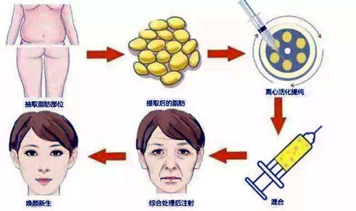 面部脂肪填充副作用是啥？福州面部脂肪填充医院医生推荐