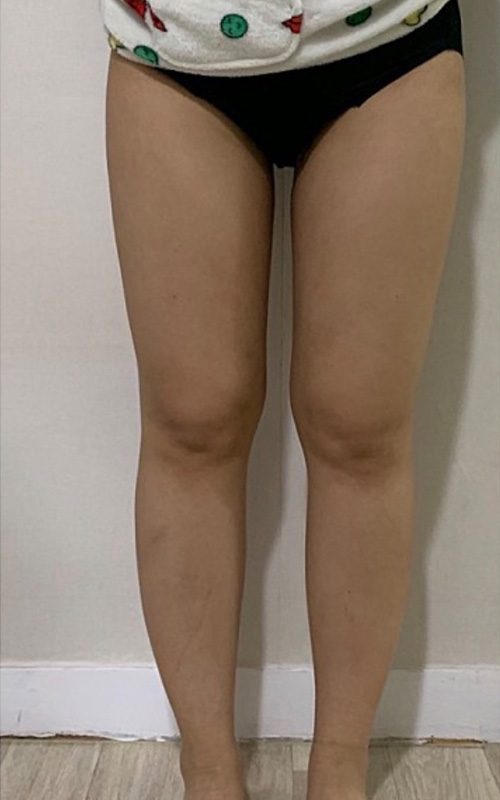 西安画美整形大腿环吸术后五个月
