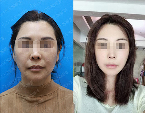 北京加减美医疗美容医院面部提升对比照片