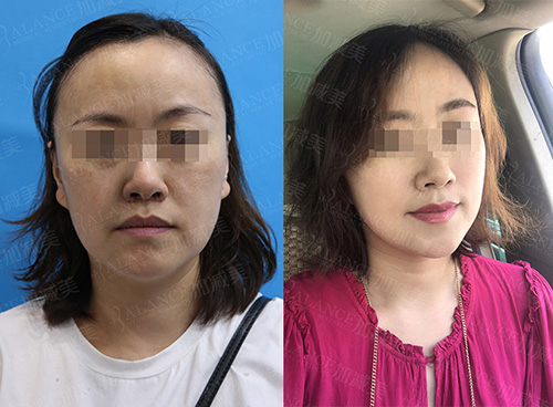 北京加减美医疗美容医院抗衰提升对比照片