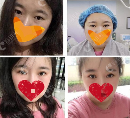 案例揭晓北京领医和韩国必当归双眼皮修复哪家自然