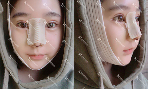 韩国迪美THE-M全切双眼皮+鼻综合术后一周