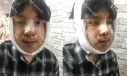 韩国迪美THE-M鼻综合+轮廓三件套手术术后三天