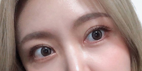 韩国Yellow整形外科双眼皮修复效果图