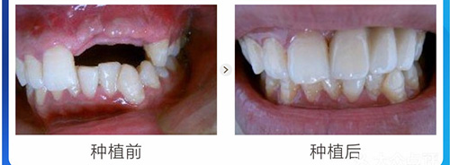 种植牙完成没有色差