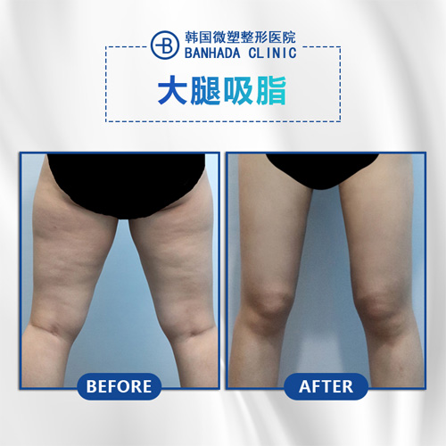 韩国微塑整形医院大腿吸脂案例