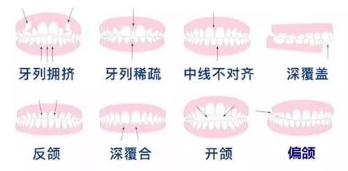 牙齿畸形需要矫正情况