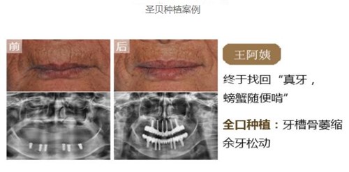 4000元的种植牙可靠吗？西安牙科哪个做种植牙便宜又好？