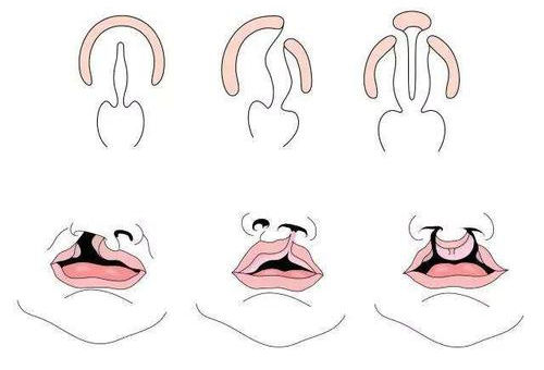 唇腭裂1度2度3度