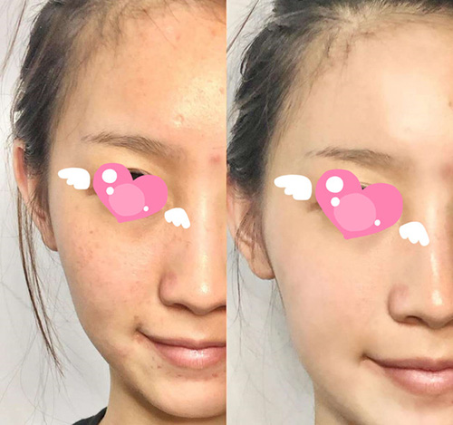 北京星灿宫医疗美容门诊皮肤治疗对比照片