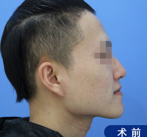 上海哪个医生做下颌角整形好