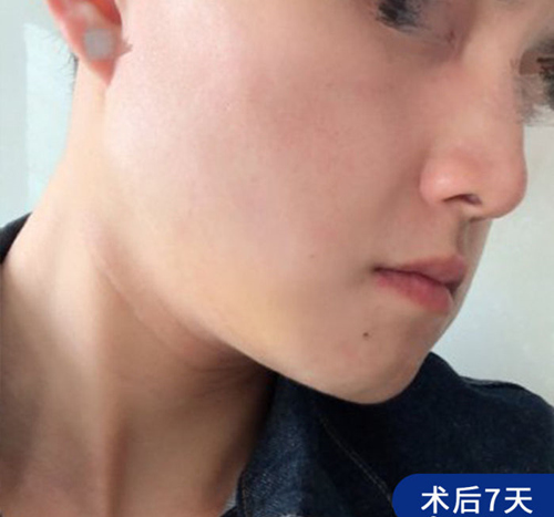 上海仁爱刘先超下颌角整形术后7天