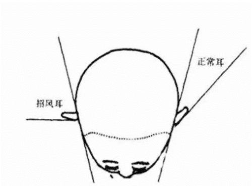 上海哪里能做耳朵整形？上海仁爱招风耳矫正原理介绍！