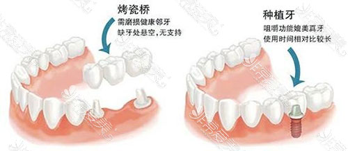 烤瓷牙和种植牙区别照片