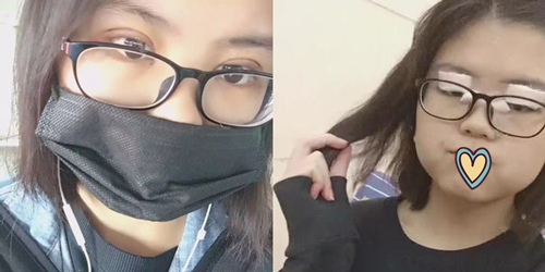 分享我在厦门海峡整形医院割双眼皮，张宏主任亲诊效果赞