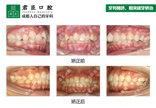 成都君臣口腔牙齿矫正好吗?多图分享成都君臣口腔正畸实例!