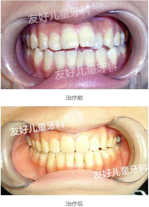 郑州小老虎友好牙科开颌矫正对比