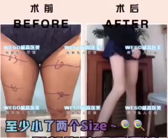 威海威高梨花医疗美容吸脂<span style=