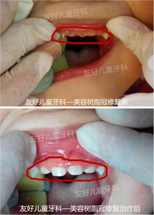 郑州友好儿童牙科乳牙龋坏修复对比