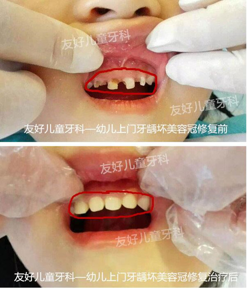 郑州友好儿童牙科能接诊几岁幼儿