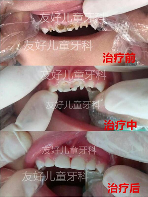 郑州小老虎儿童牙科门牙龋坏治疗对比