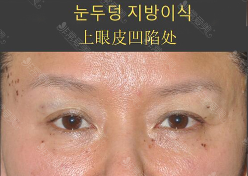 韩国WILL整形外科脂肪填充眼窝成功案例
