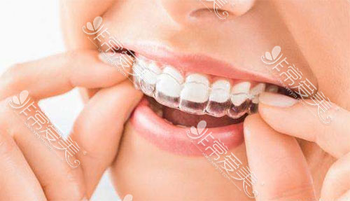 为什么牙医不建议隐形牙套