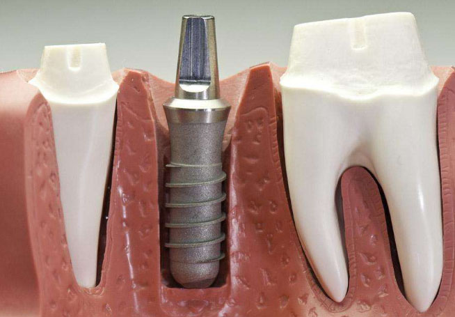 种植牙图片