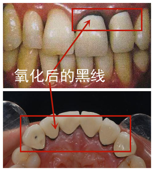 镍铬合金烤瓷牙后由于氧化出现的黑线