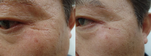 自体真皮再生术改善眼角皱纹效果图