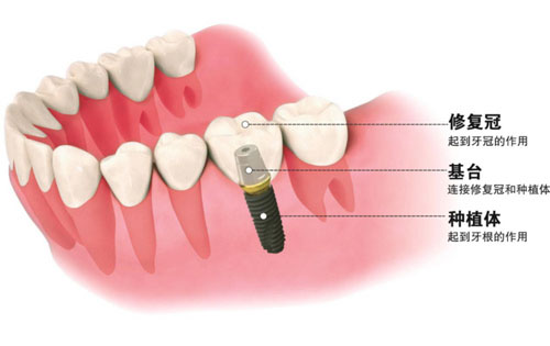 种植牙动画示意图