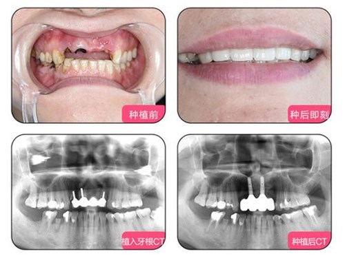 福州种植牙大概需要多钱？福州口腔医院种植牙费用明细