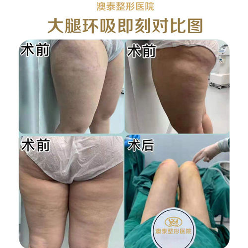 湛江澳泰整形医院大腿吸脂