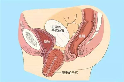 正常子宫位置与脱垂子宫位置演示图