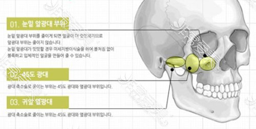 颧骨手术骨骼分析图
