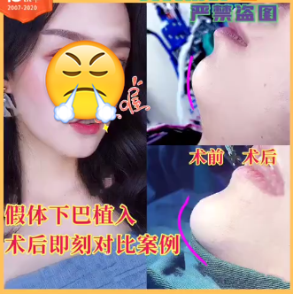 宁波尚丽整形医院下巴<span style=