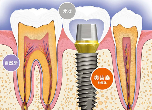 韩国奥齿泰种植体
