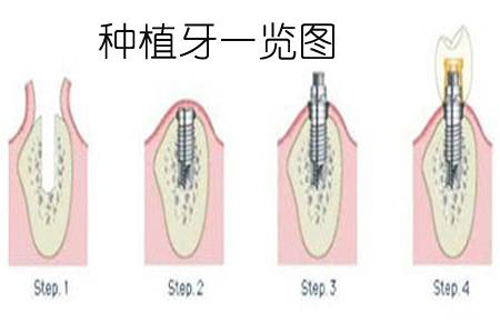 说说我种牙的流程与感受，需要去几次医院才可种牙成功！