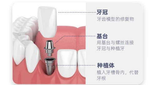 种植牙手术分布解析