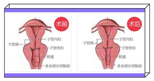 正规阴道紧缩术的妇科医院价格贵吗?分享私密整形的价格表!