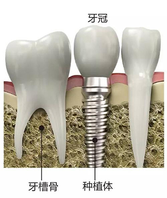 种植体牙槽骨牙冠位置展示图